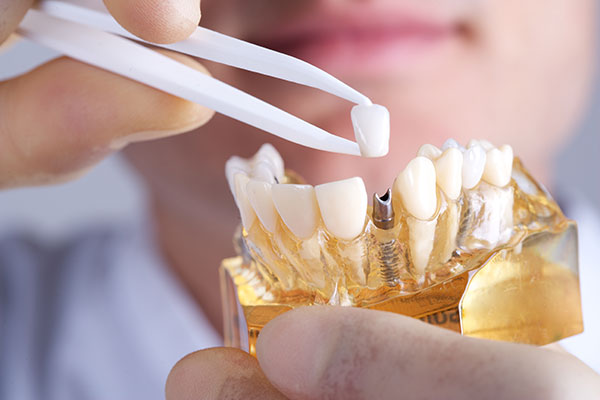 Dental Implants Model