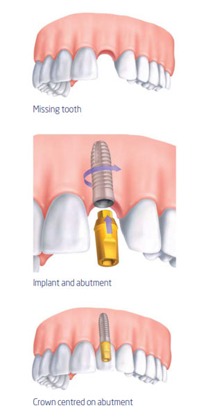 Implant Procedure Diagram